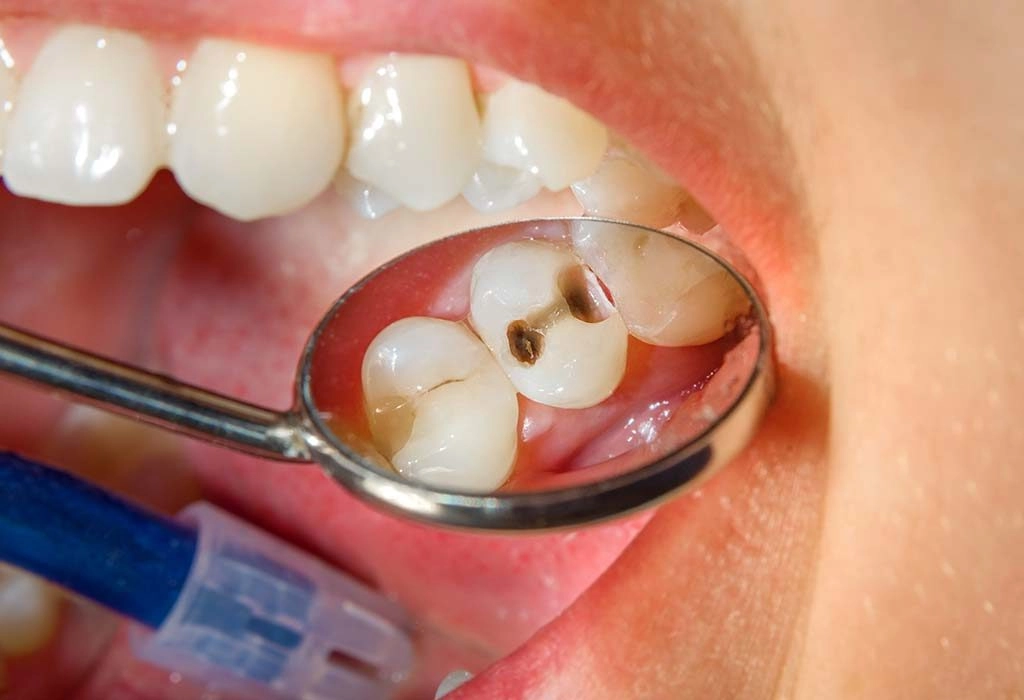 Cárie Dental: Evolução do Diagnóstico e Tratamento na Odontologia