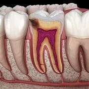 Cárie Dental: Evolução do Diagnóstico e Tratamento na Odontologia